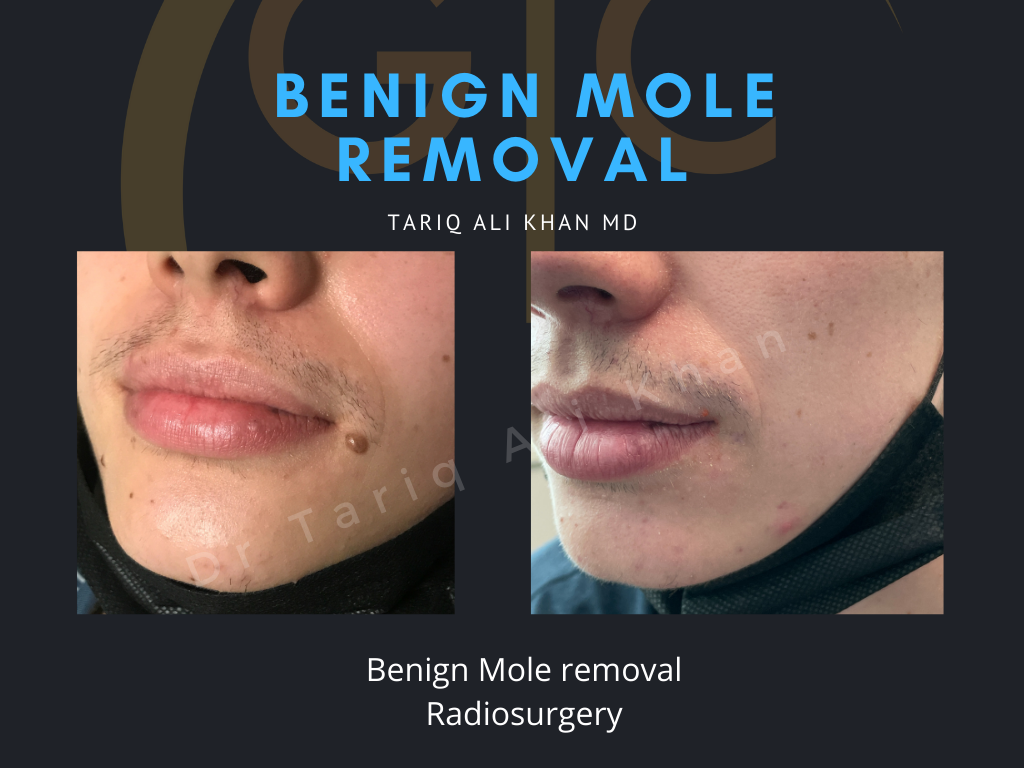 Gentle Care Laser Tustin & Long Beach Before and After picture - Mole Removal